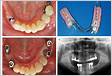 Partial edentulism and removable denture construction